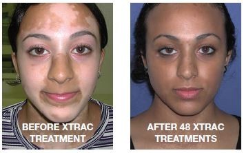 get-rid-of-vitiligo-in-colonia-municipality-in-the-federated-states-of-micronesia-call-27710732372-tattoo-removal-oil-in-yellow-springs-in-ohio-small-4