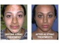 get-rid-of-vitiligo-in-colonia-municipality-in-the-federated-states-of-micronesia-call-27710732372-tattoo-removal-oil-in-yellow-springs-in-ohio-small-4