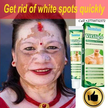 get-rid-of-vitiligo-in-colonia-municipality-in-the-federated-states-of-micronesia-call-27710732372-tattoo-removal-oil-in-yellow-springs-in-ohio-big-0